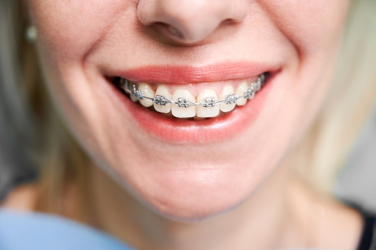 Myths about getting Braces as an Adult